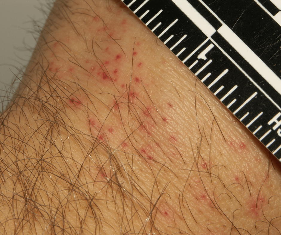 bed bug bites