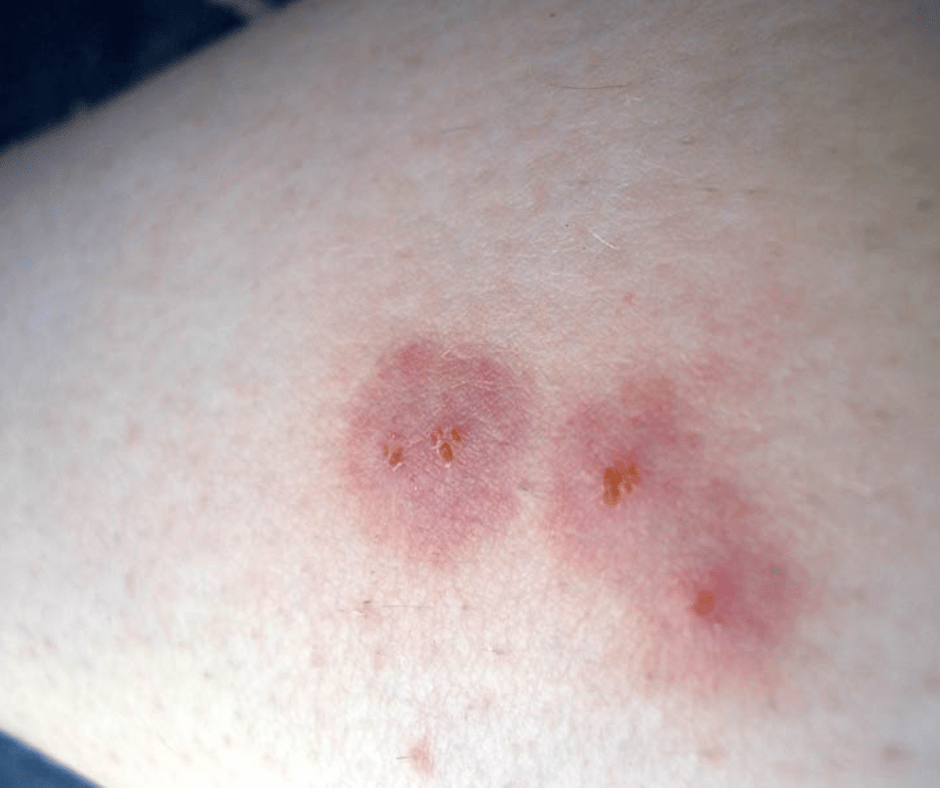 spider bite bug bites